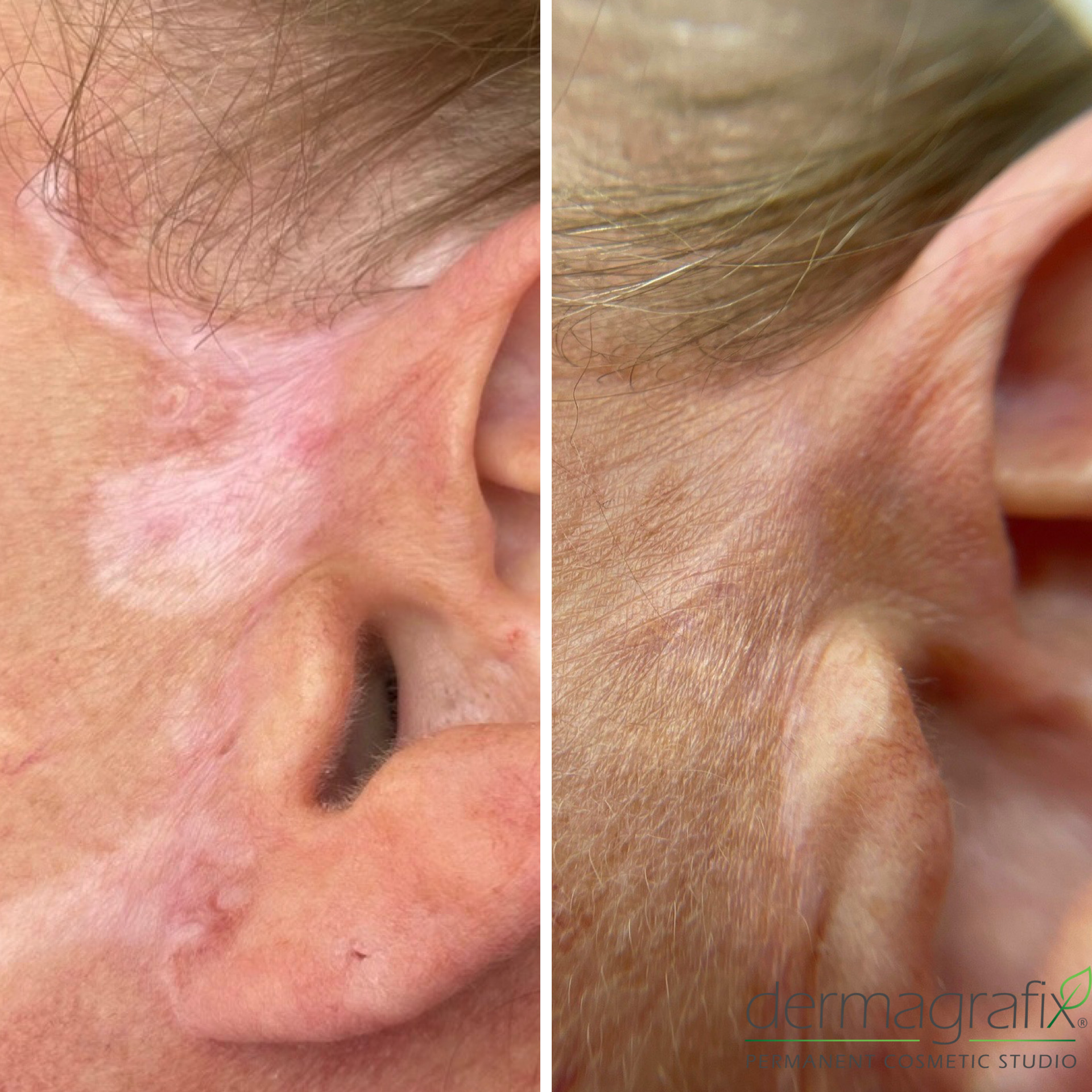 Hypopigmented scarring in front of the ear before and after skin re-pigmentation tattooing
