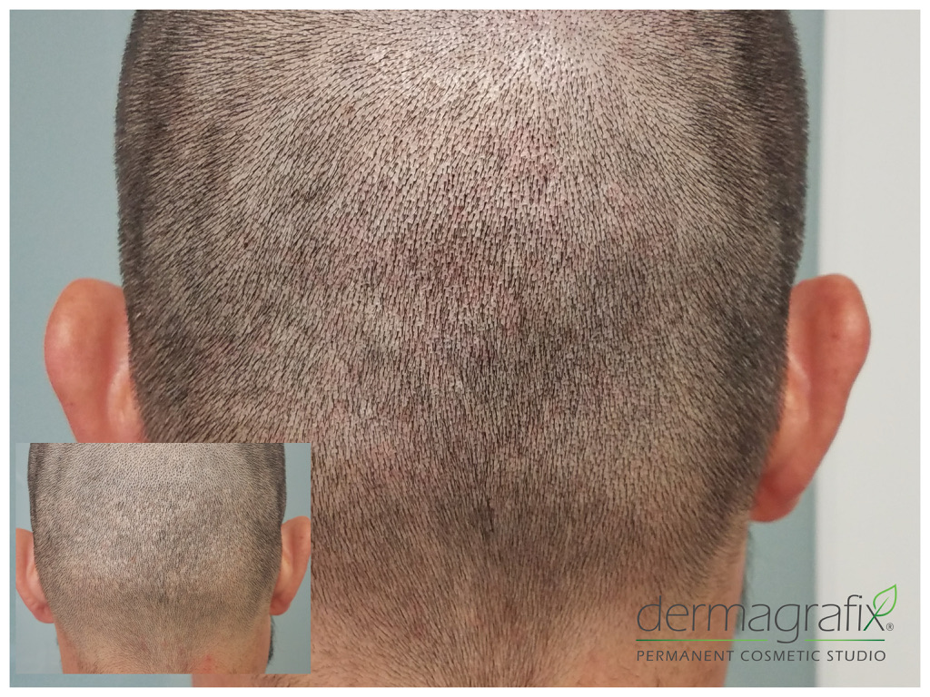 Scalp micropigmentation across the back and crown of a closely cropped head
