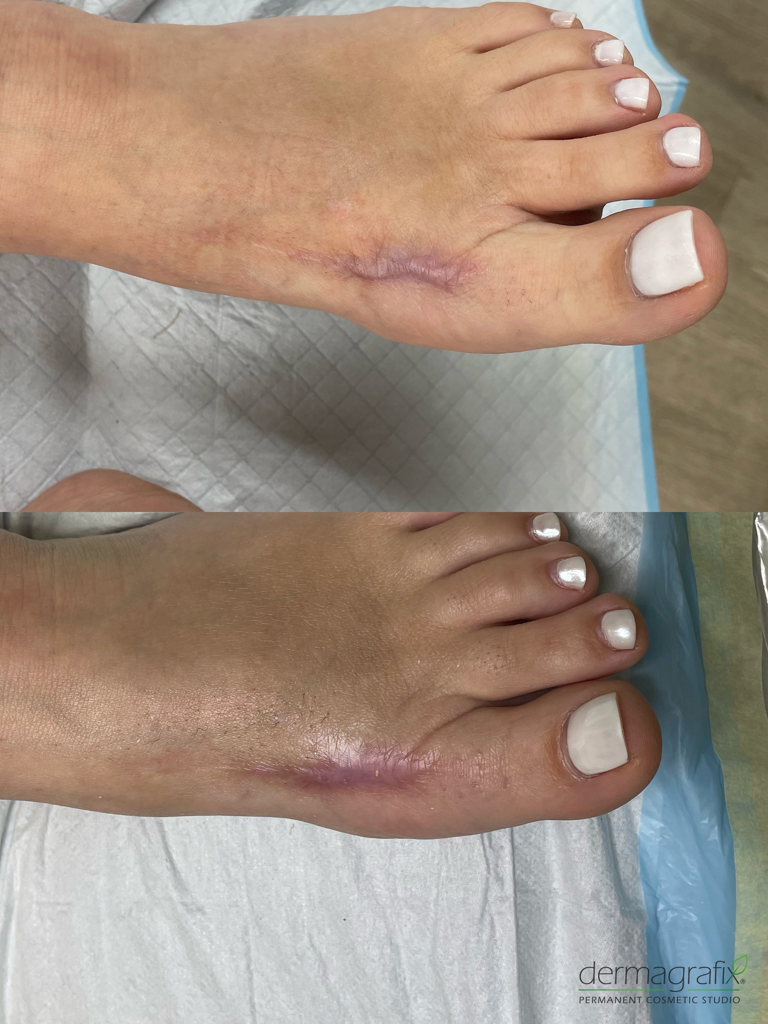 Raised hypertrophic surgical scar on the top of the foot before and after ink-less scar relaxation, appearing flatter and less raised