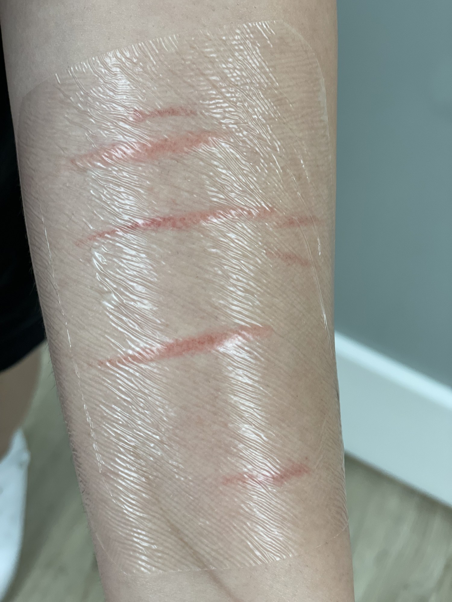 Client 3 forearm right after a session, red lines under a clear dressing