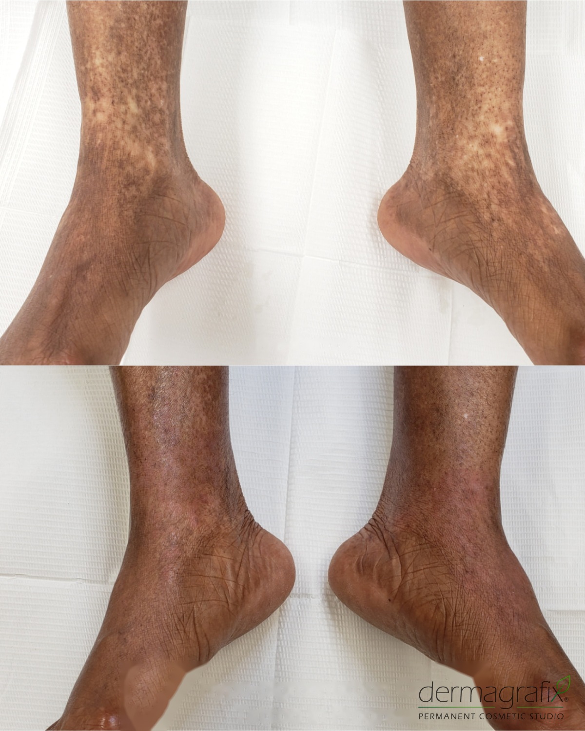 Hypo-pigmentation on the ankles of a client with deeper, melanin-rich skin before and after skin re-pigmentation matched to the surrounding tone