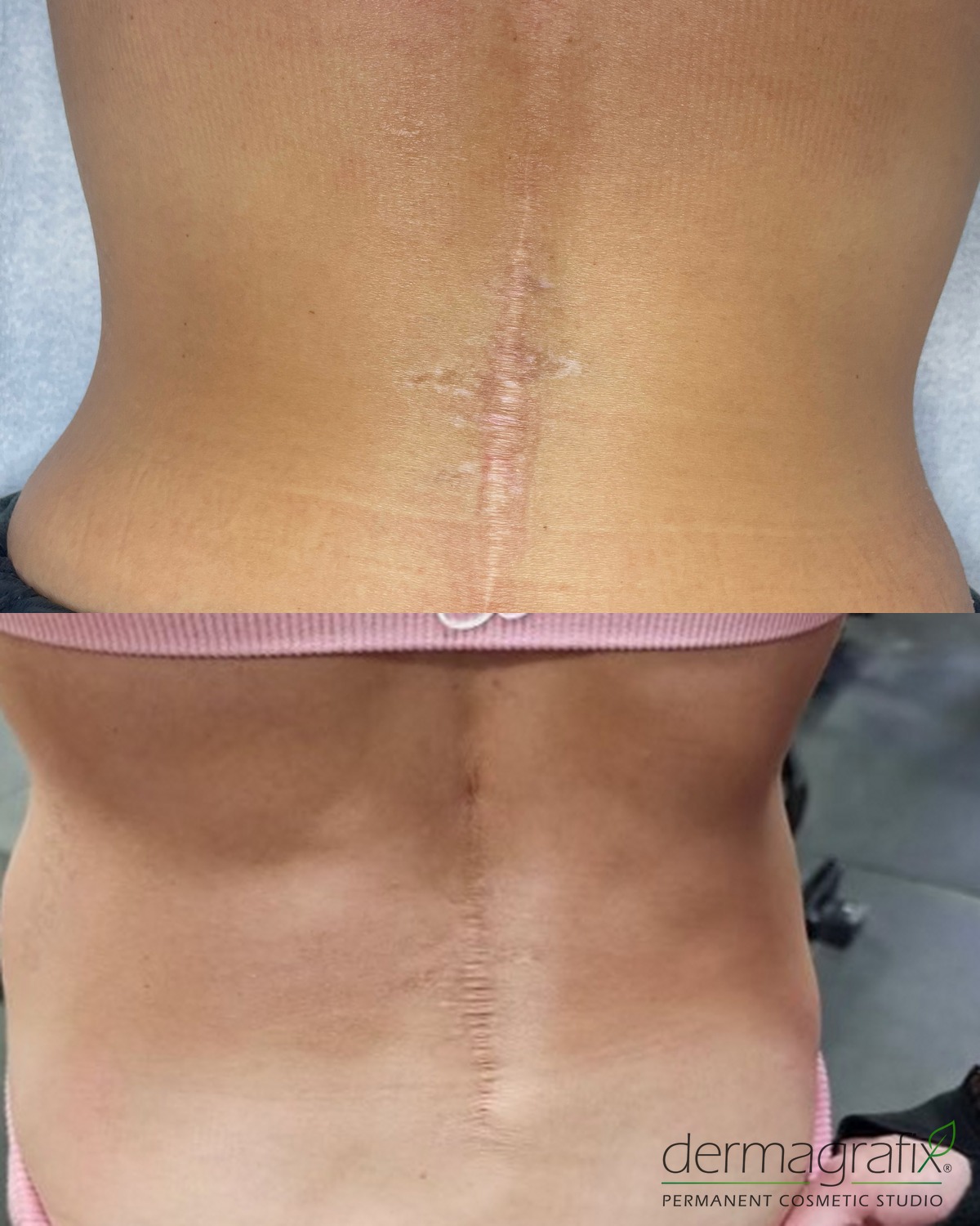 Vertical surgical scar on the lower back before and after ink-less scar revision, with a paler, flatter and less textured scar line