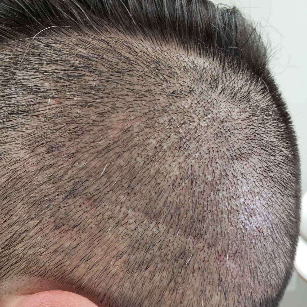 Scalp micropigmentation for scars | SMP for hair transplant scars