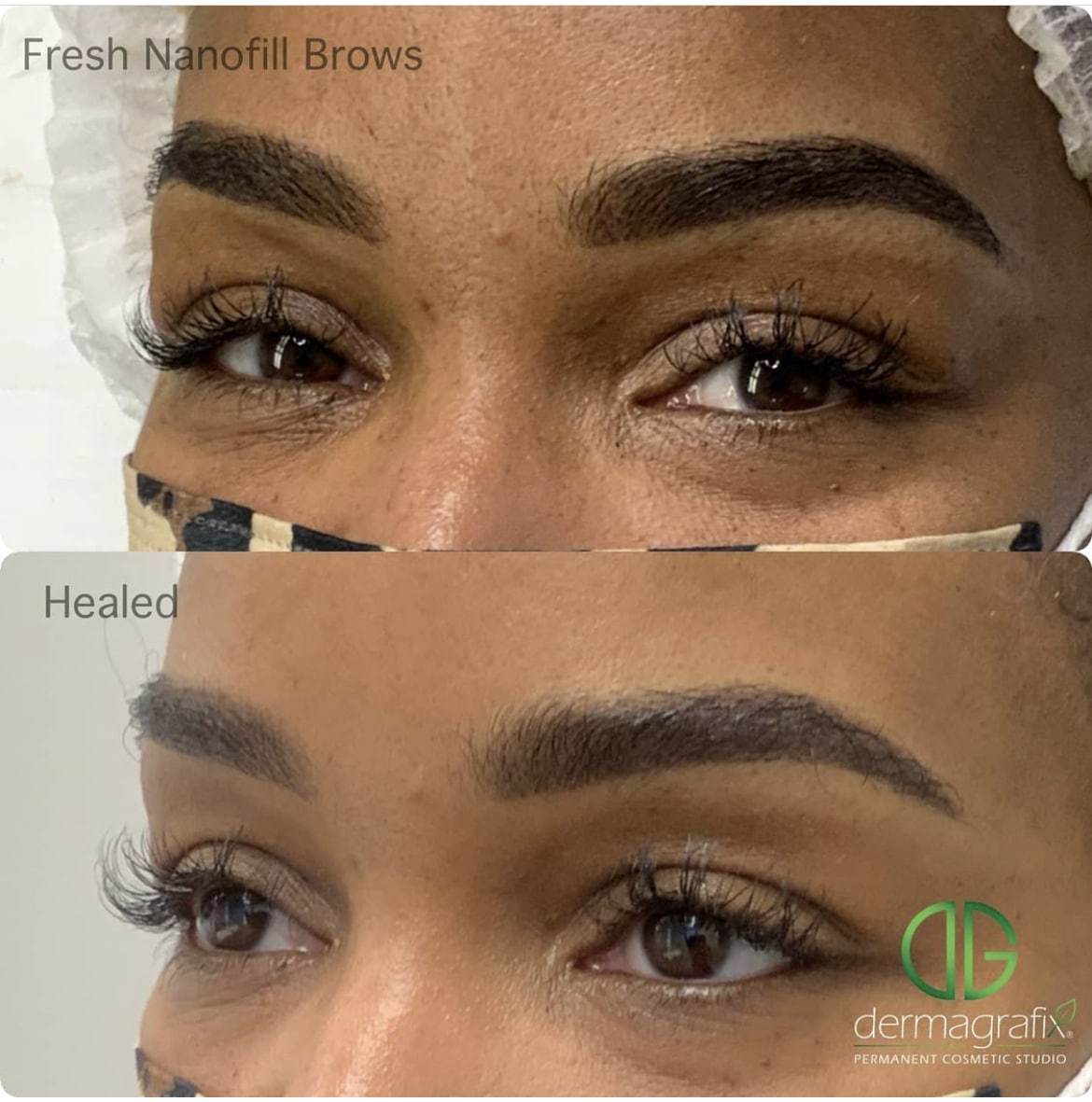 Permanent Eyebrows - The Dermatography Clinic